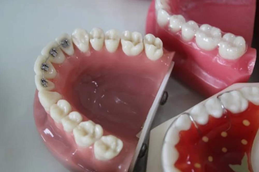 تقويم الأسنان: أشهر الأنواع ولمحة عن التكاليف تقويم الأسنان: أنواعه وفوائده وكيفية العناية به