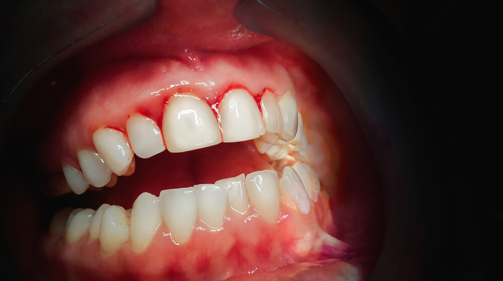 Periodontal hastalıklar -diş eti estetiği - pembe estetik Periodontal Hastalıklar